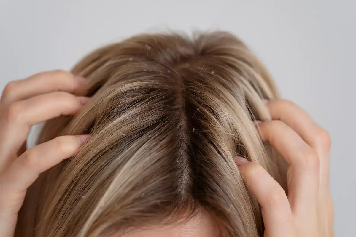 damaged hair roots after hair dye